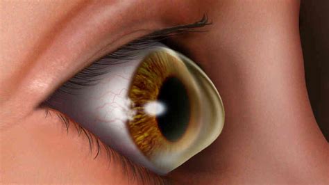 Keratoconus Valenia Health Services