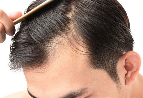 Does Minoxidil Cause Shedding Ds Healthcare Group