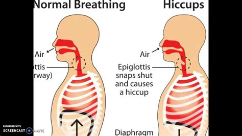 How To Stop Hiccups In 10 Seconds Youtube