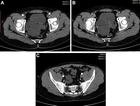 A Contrast Enhanced Computed Tomography Cect Pelvis Axial Image