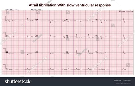 Electrocardiogram Show Atrial Fibrillation Slow Ventricular Stock