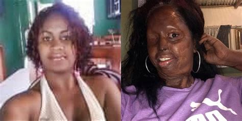 Acid Attack Victim Vows ‘im Still A Beautiful Woman Vida Newspaper