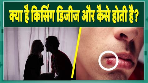 Kissing Disease एक दूसरे का झूठा खाने से हो सकती है किसिंग डिजीज