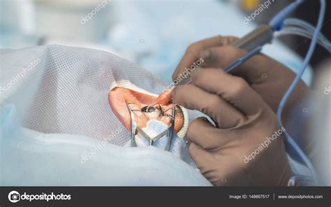 Crystalline lens replaceable surgical method Stock Photo by ©sdigitall ...