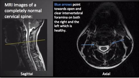 The Pinched Nerve in Your Neck Most Likely Isn't Actually a Pinched Nerve