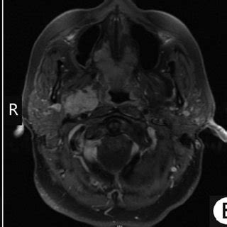 A Coronal T1 Weighted MRI Sequence Demonstrating A Lobulated Well