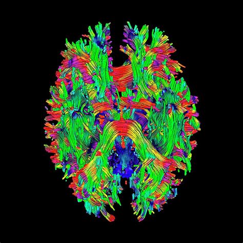 Brain Tumour By Simon Fraser Science Photo Library