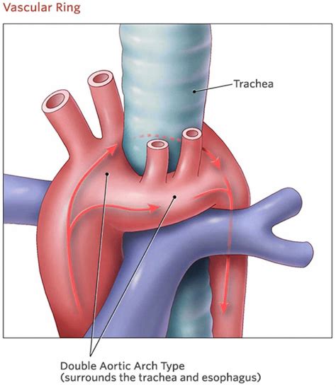 Vascular Ring Causes Symptoms Diagnosis Treatment Prognosis