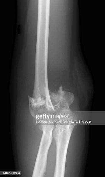 Broken Elbow X Ray Photos and Premium High Res Pictures - Getty Images