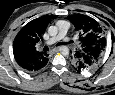 Thoracic Aorta Blunt Trauma