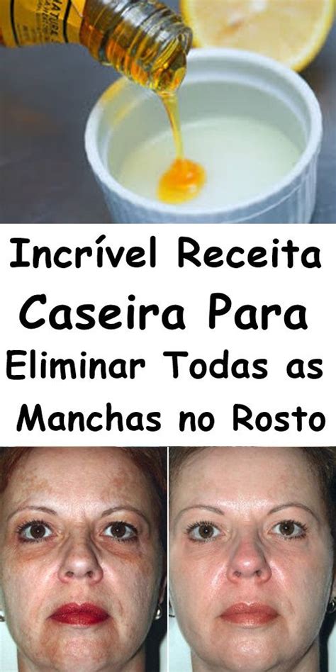 Receita Caseira Para Eliminar Manchas Escuras No Rosto Passo A Passo