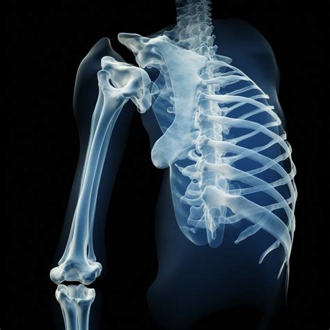 Most Common Complications of a Humerus Fracture