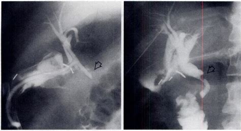 Figure L A Cholangiogram Obtained Via A T Tube Week After