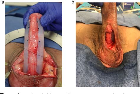 Penile Implant Before After