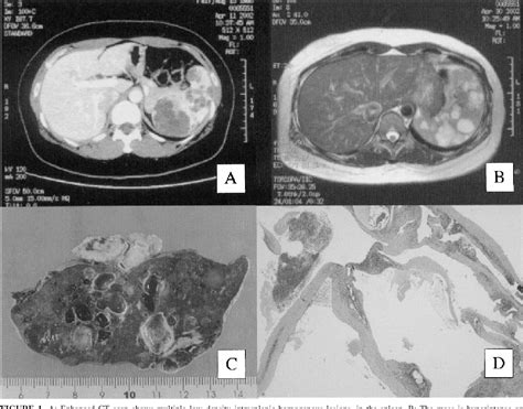 Figure 1 From Hand Assisted Laparoscopic Splenectomy For Splenic