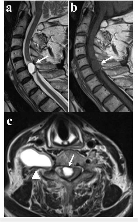 Figure From Acute Neurological Aggravation Caused By Intratumoral