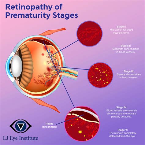 Retinopathy Of Prematurity Lj Eye Institute