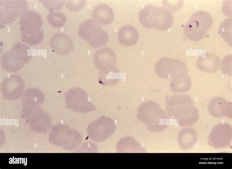 Microfotografía De Un Frotis De Sangre Con Dos Formas De Anillo Del Parásito Causante De La