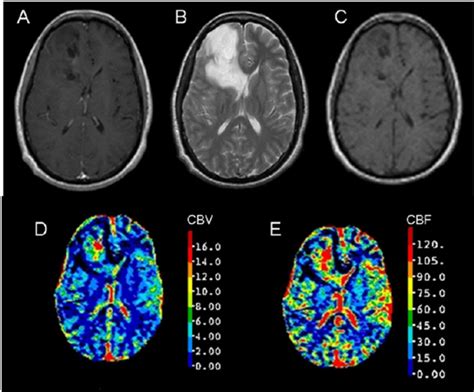 DCE images of a patient with histologycally proved astrocytoma grade ...