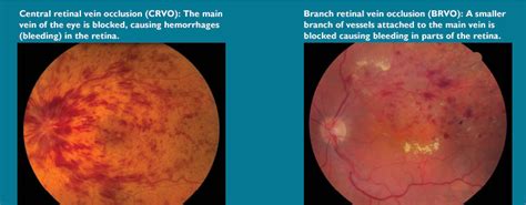 Retinal vein occlusion; Thrombosis, Retinal Vein