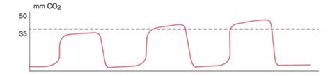 Capnography Core Em