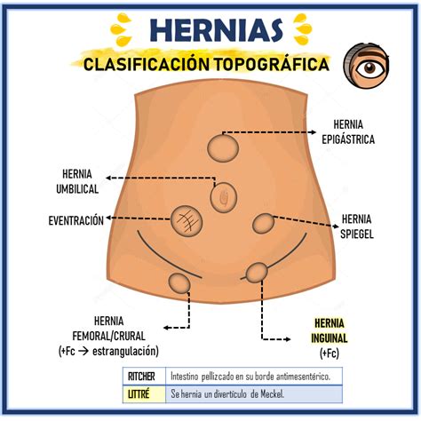 Hernia Surgery Laparoscopic Hernia Surgery Diagnosis And Treatment