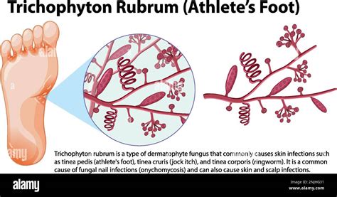 Trichophyton Rubrum fungal infection illustration Stock Vector Image & Art - Alamy