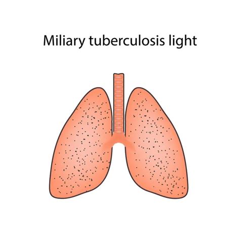 Types Of Tuberculosis Miliary And Disseminated Pulmonary Tuberculosis