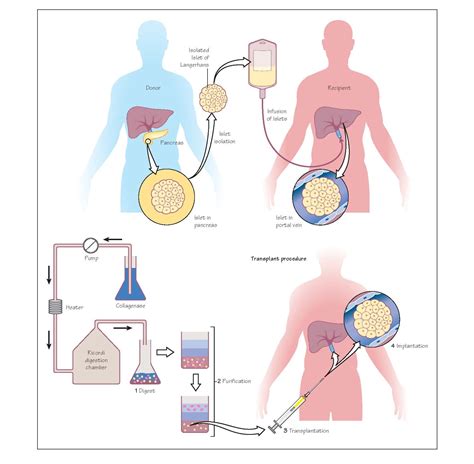 Islet Transplantation - pediagenosis