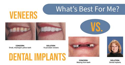 Veneers vs. Dental Implants: What is Best for Me? - Freeman Smiles ...