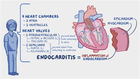 Endocarditis: Nursing - Osmosis Video Library