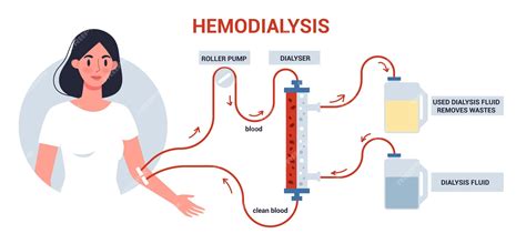 Premium Vector | Hemodialysis for kidney treatment infographics. woman