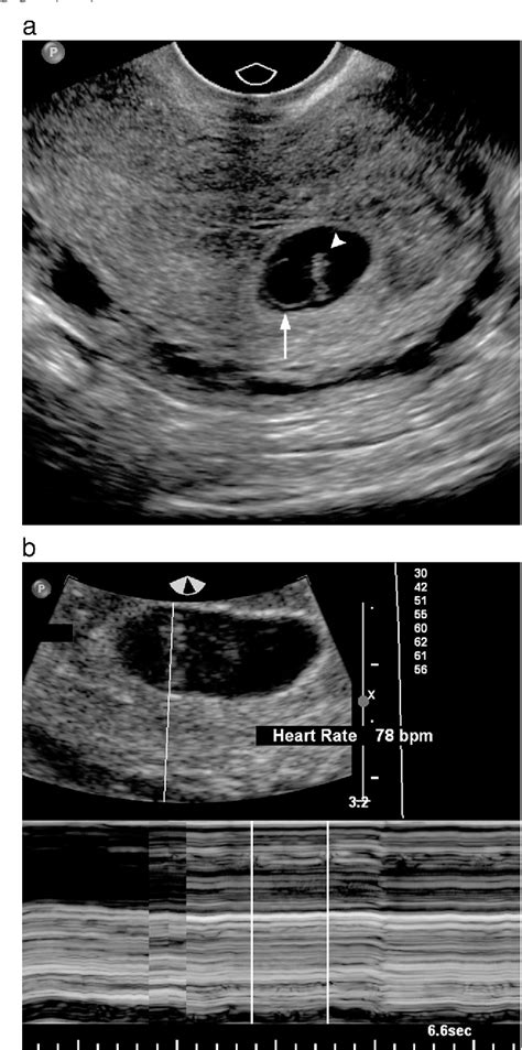 Figure 1 From Pearls And Pitfalls In First Trimester Obstetric Sonography Semantic Scholar