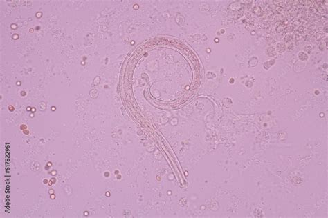 View In Microscopic Strongyloides Stercoralis Or Threadworm In Human Stool Parasite Infection