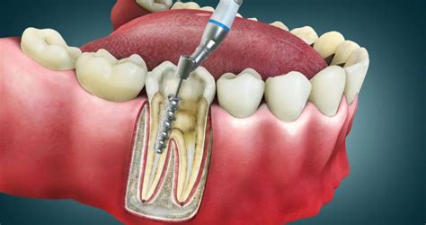 What Is A Root Canal Root Canal Treatment Side Effects