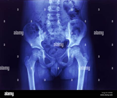 Radiograf A De Una Pelvis Normal De Un Ni O Fotograf A De Stock Alamy