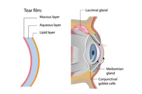 Meibomian Gland Cyst