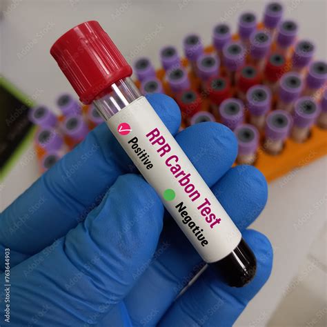 Blood Sample For Rpr Carbon Test Vdrl Syphilis Screening Test To