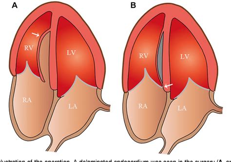 Figure From Interventricular Septal Hematoma Following Correction Of