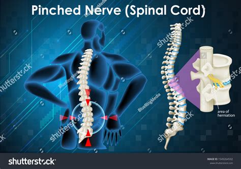 Diagram Showing Pinched Nerve Human Illustration Stock Vector (Royalty ...