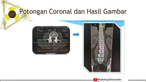 Teknik Pemeriksaan CT Scan Lumbal Spine YouTube