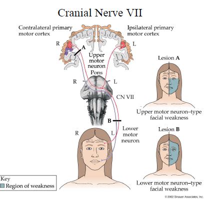 Cranial Nerves Disorders Flashcards | Quizlet