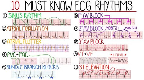 Most Common ECG Patterns You Should Know YouTube