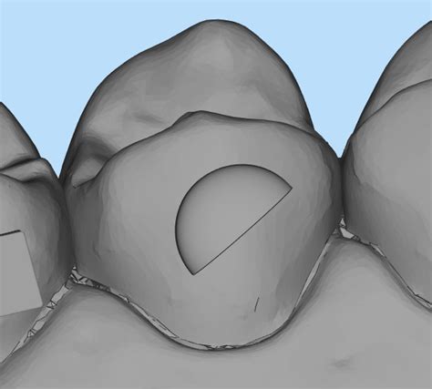 Clear Aligner Attachments Explained: Enhancing Orthodontic Treatment