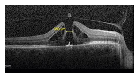 (a) OCT image showing stage II macular hole with a diameter of 389 μm... | Download Scientific ...