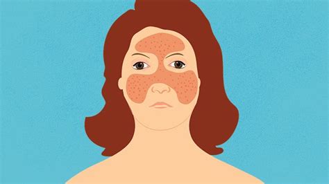 How to Identify Rashes and Other Lupus Skin Symptoms