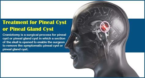 Pineal gland cyst headache information | aboutheadache