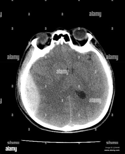 Traumatic Brain Injuries CT Scan Stock Photo Alamy