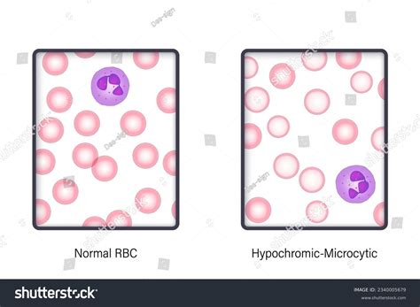 Hypochromic Anemia Photos and Images | Shutterstock