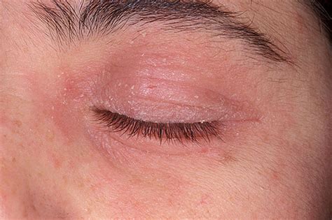 dermatitis on eyelid - pictures, photos